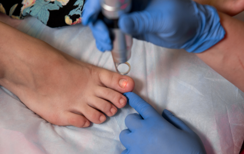 Ingrown Toenail