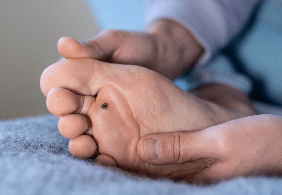 Verrucas: Causes, Symptoms and the Most Effective Treatments