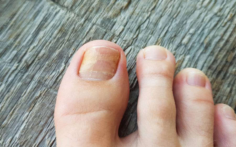 Why Does My Fungal Toenail Keep Coming Back?